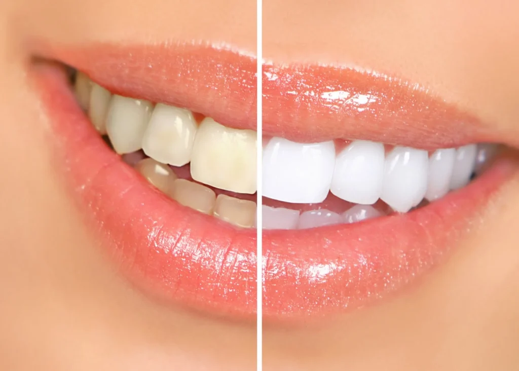clareamento dental analia franco e tatuape