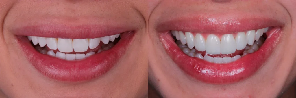 lente de contato dental antes e depois