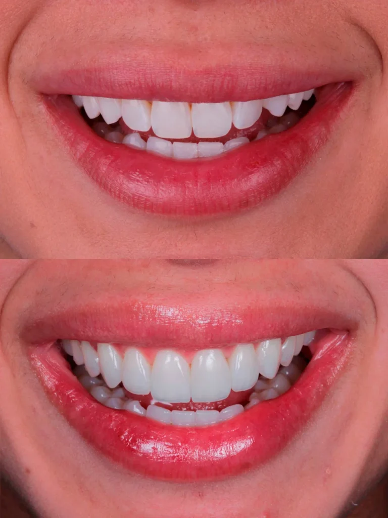 lente de contato dental antes e depois