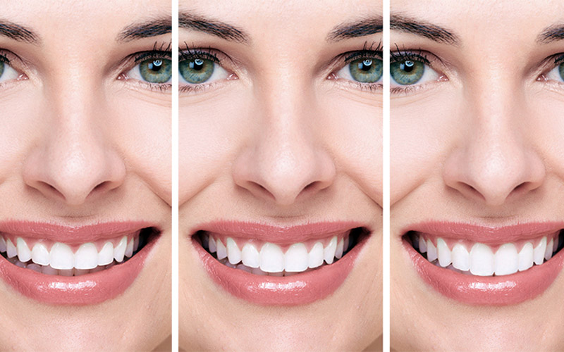 lente de contato dental com planejamento