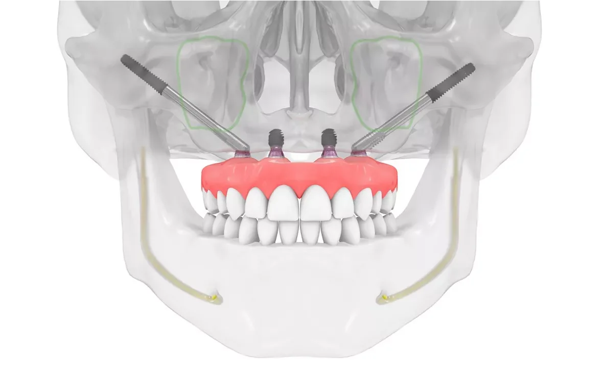 implante zigomatico 3d analia franco